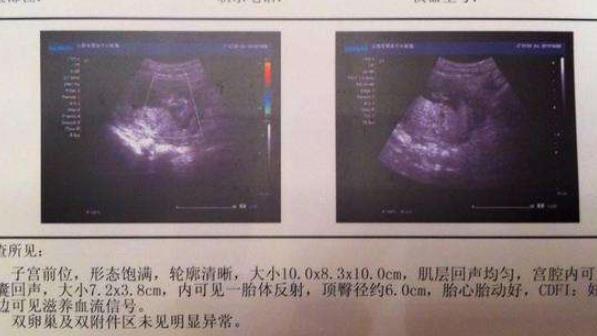怀孕胎囊形状看男女