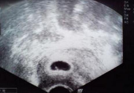 孕14周b超看胎儿性别