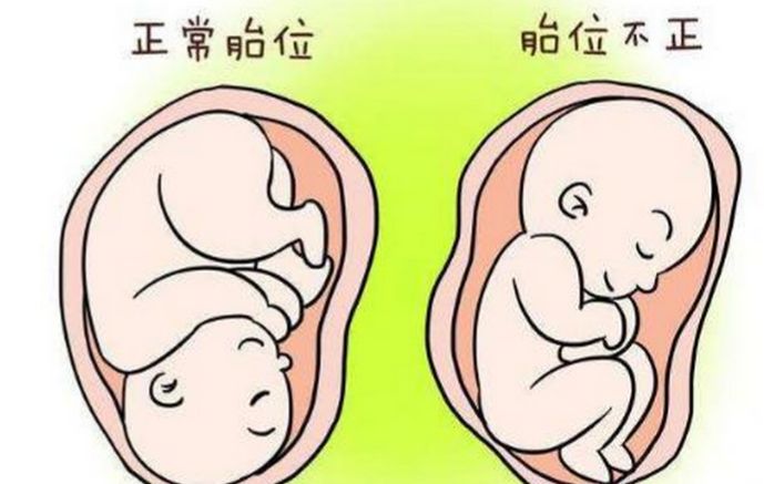 胎位头位是什么意思,如果胎位异常怎么办呢.jpeg
