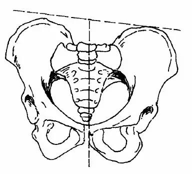 为什么要做骨盆测量？骨盆测量怎么测？.jpg