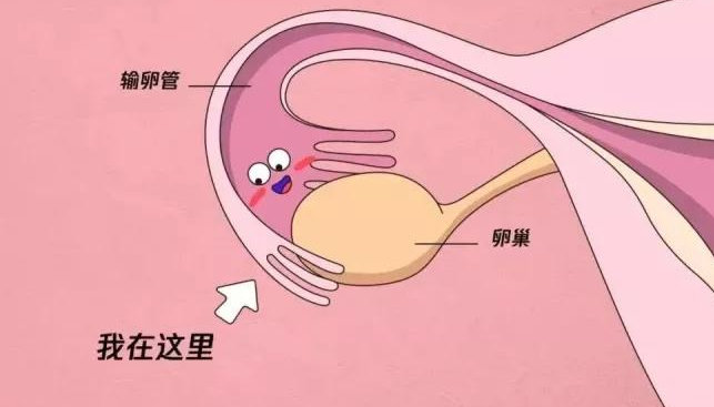 女性输卵管不孕.png