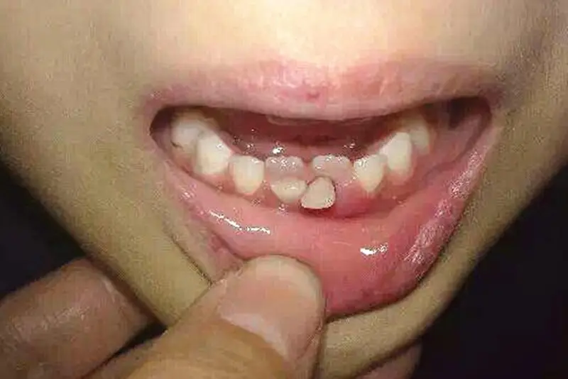 1岁宝宝牙齿被腐蚀照片.jpg