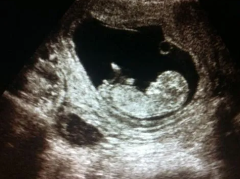 看胚胎形状可以知道男孩女孩吗.png