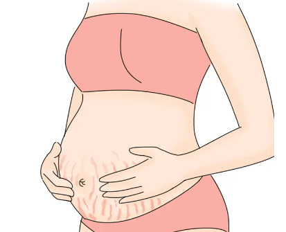 妊娠纹的位置是否与胎儿性别有关.png
