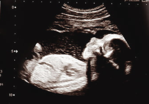 怀孕期间如何判断腹中胎儿性别.png